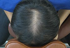 모발이식 전후관리 치료 전