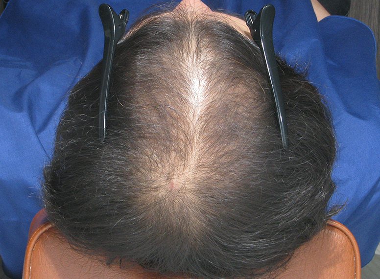 열성탈모 치료 전