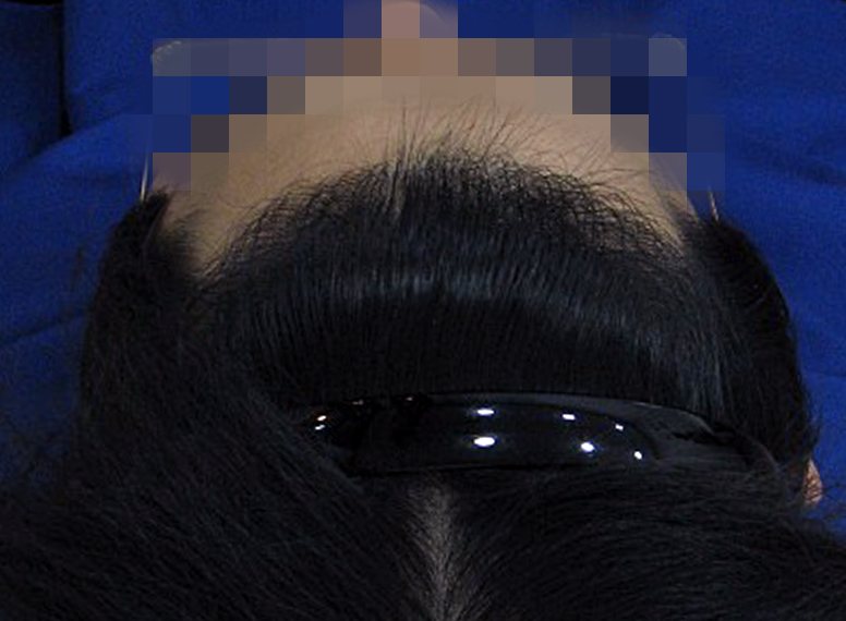 앞머리탈모 치료 후